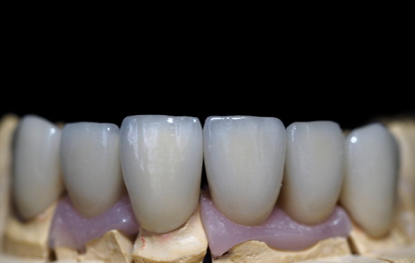 fija_metal_ceramica