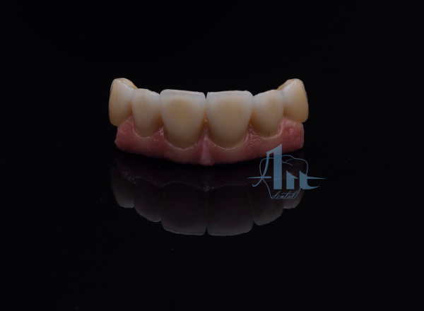 fija_metal_ceramica
