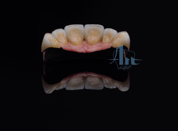 fija_metal_ceramica