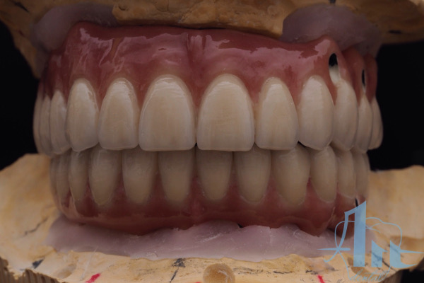 fija_metal_ceramica