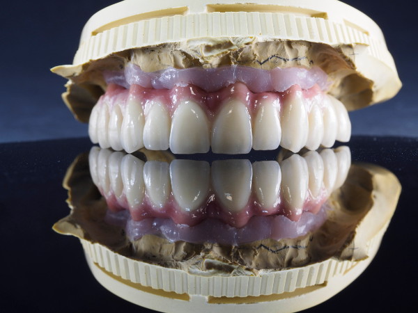implante_metal_ceramica