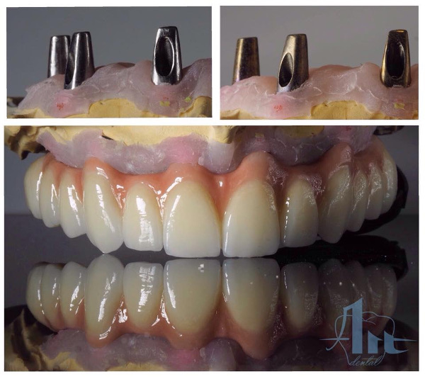 implante_zirconio_ceramica