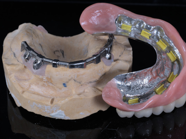 removible_sobre_dentadura